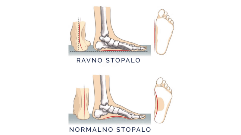 ravno stopalo