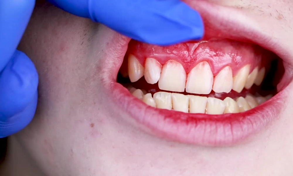 Povlačenje desni napreduje od blagog povlačenja i osetljivosti do sve većeg izlaganja korena i klimanja zuba