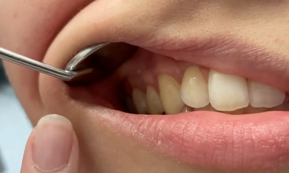 Znakovi povlačenja desni uključuju crvenilo, osetljivost, krvarenje i vidljivo izlaganje korena zuba